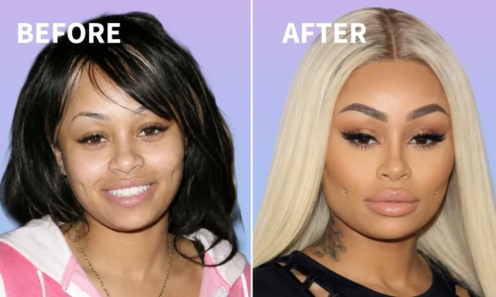 blac chyna before after surgery